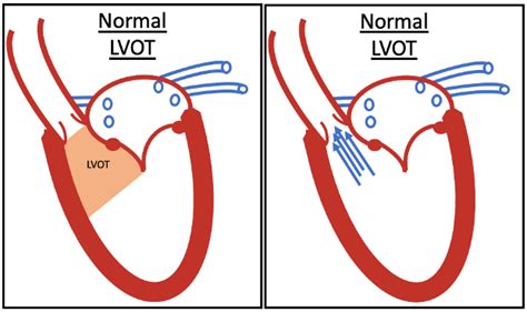 lv outflow tract obstruction